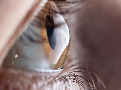 Keratoconus