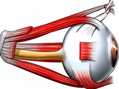 Squint Eye (Strabismus)